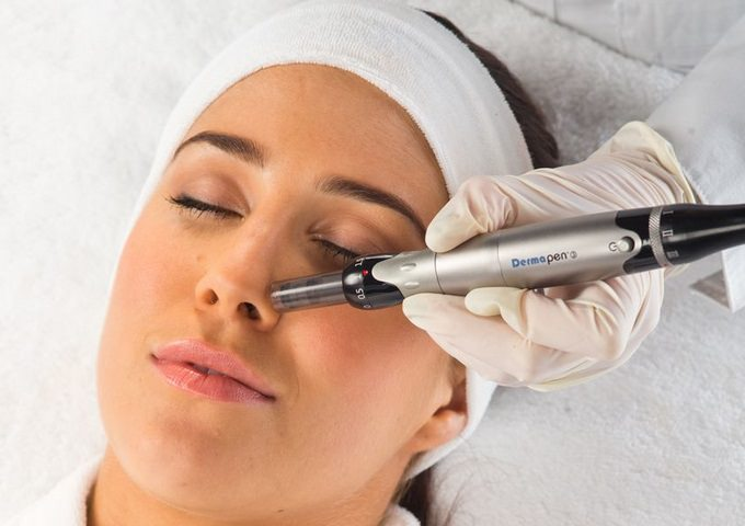 Dermapen Treatment