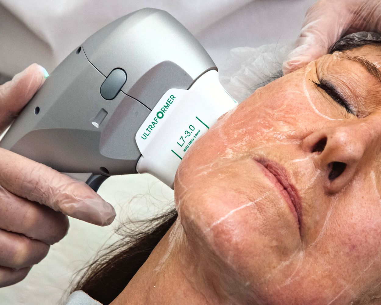 Dermaroller Treatment