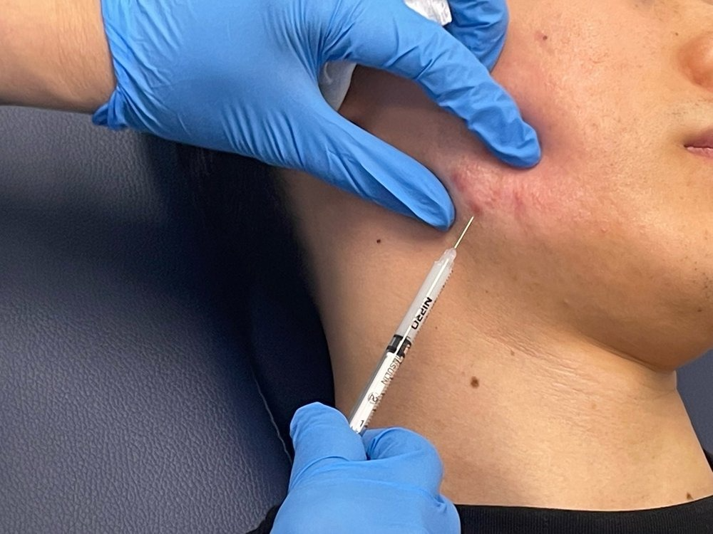 Intralesional Injection Therapies