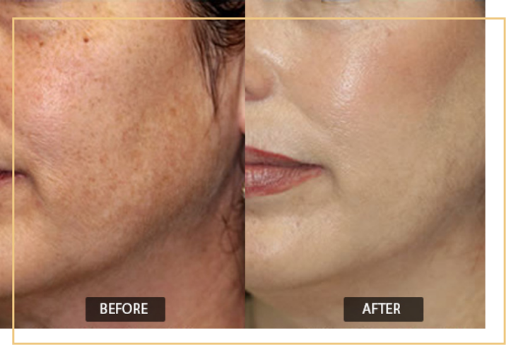 Laser Skin Toning Treatment