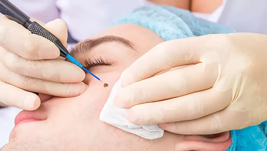 Radiofrequency Cauterisation Treatment
