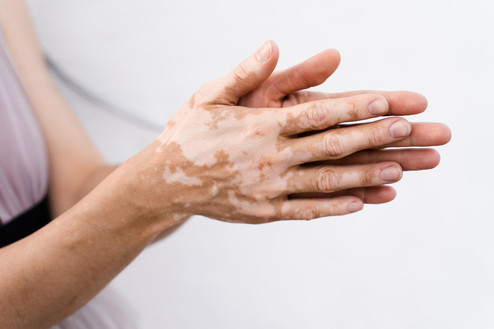 Vitiligo treatment consultation