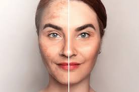 Pigmentation and melasma treatment consultation